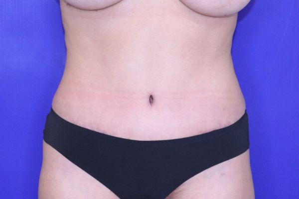 Tummy Tuck after at Farber Plastic Surgery in Delray Beach, FL