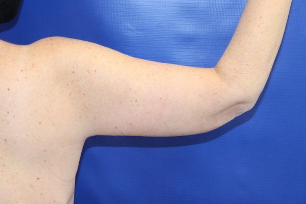 CoolSculpting after at Farber Plastic Surgery in Delray Beach, FL