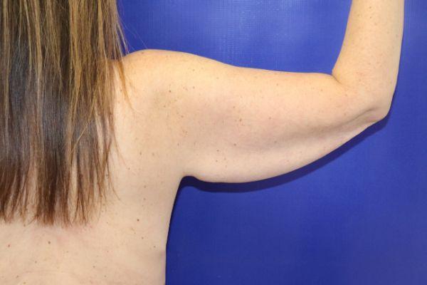 CoolSculpting before at Farber Plastic Surgery in Delray Beach, FL