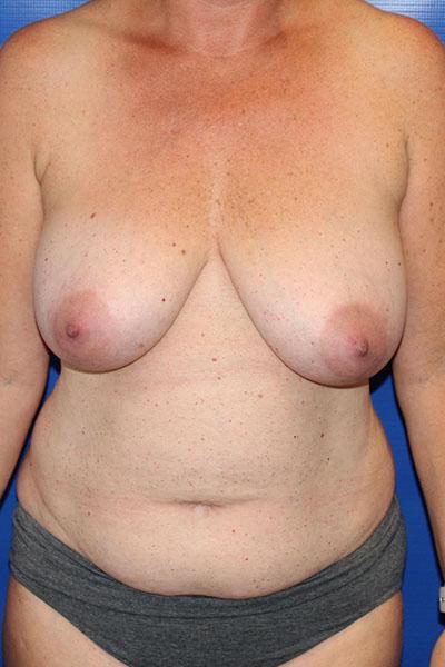 Mommy Makeover before at Farber Plastic Surgery in Delray Beach, FL