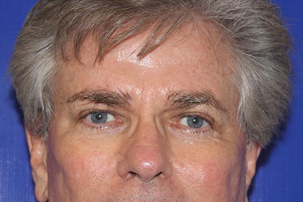 Farber Plastic Surgery blepharoplasty after — Delray Beach, FL
