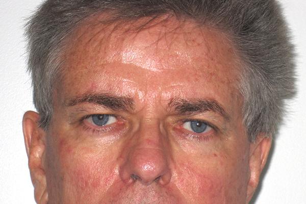 Blepharoplasty before at Farber Plastic Surgery in Delray Beach, FL