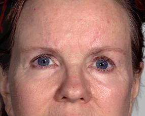 Blepharoplasty after at Farber Plastic Surgery in Delray Beach, FL