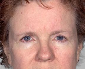 Blepharoplasty before at Farber Plastic Surgery in Delray Beach, FL