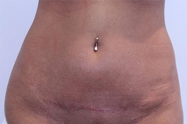 Tummy Tuck after at Farber Plastic Surgery in Delray Beach, FL