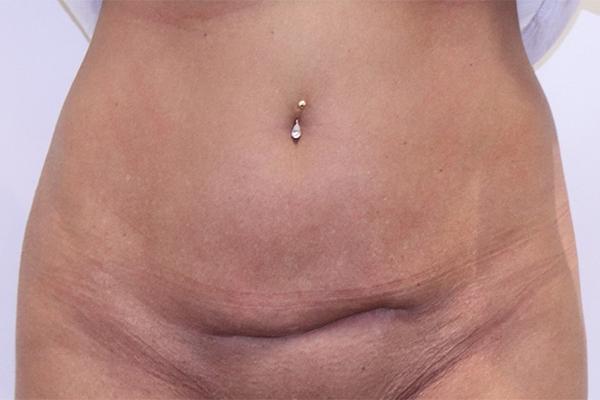 Tummy Tuck before at Farber Plastic Surgery in Delray Beach, FL