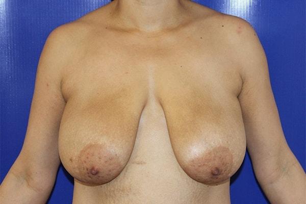 Breast Lift before at Farber Plastic Surgery in Delray Beach, FL