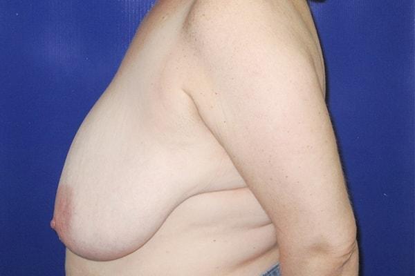 Breast Reduction before at Farber Plastic Surgery in Delray Beach, FL