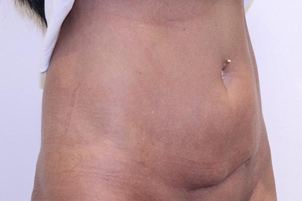 Mini Tummy Tuck before at Farber Plastic Surgery in Delray Beach, FL