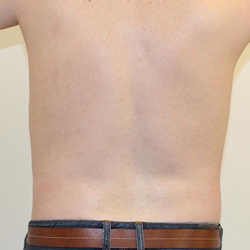 Liposuction after at Farber Plastic Surgery in Delray Beach, FL