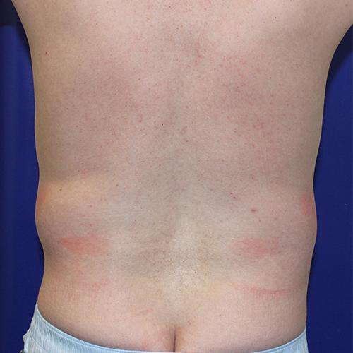 Liposuction before at Farber Plastic Surgery in Delray Beach, FL
