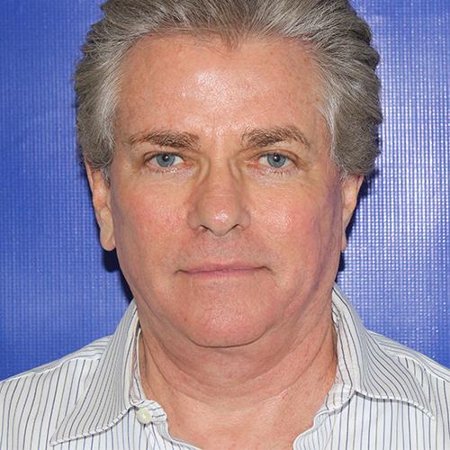 Facelift after at Farber Plastic Surgery in Delray Beach, FL
