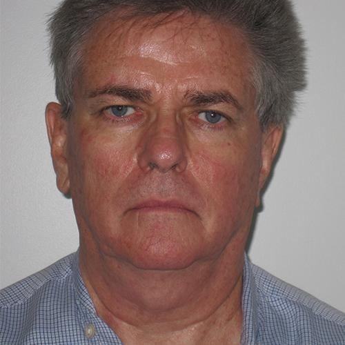 Facelift before at Farber Plastic Surgery in Delray Beach, FL