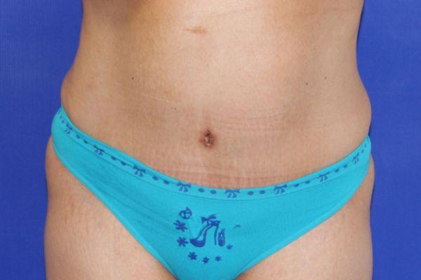 Farber Plastic Surgery tummy tuck after — Delray Beach, FL