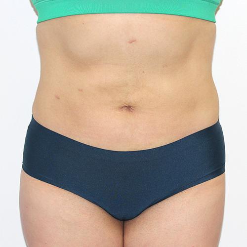 Liposuction after at Farber Plastic Surgery in Delray Beach, FL