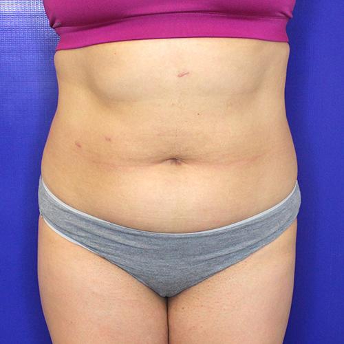 Liposuction before at Farber Plastic Surgery in Delray Beach, FL