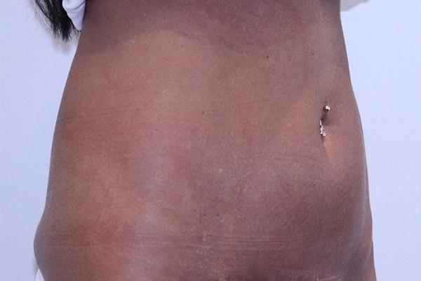 Farber Plastic Surgery tummy tuck after — Delray Beach, FL