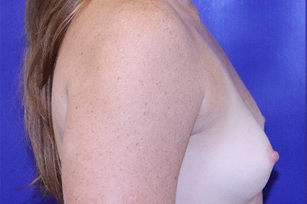 Breast Augmentation before at Farber Plastic Surgery in Delray Beach, FL