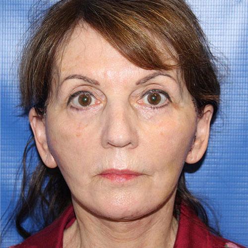 Farber Plastic Surgery facelift after — Delray Beach, FL