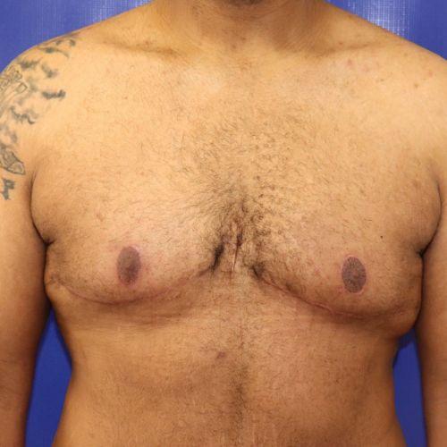 Farber Plastic Surgery gynecomastia after — Delray Beach, FL