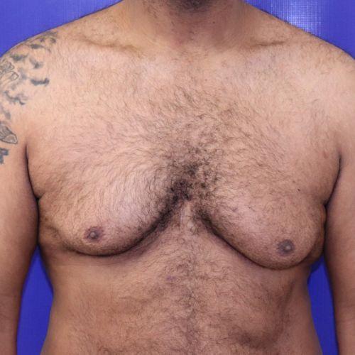 Gynecomastia Surgery before at Farber Plastic Surgery in Delray Beach, FL