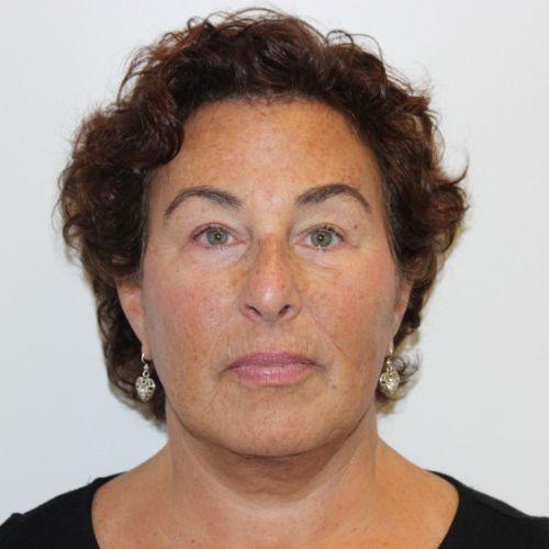 Farber Plastic Surgery facelift after — Delray Beach, FL