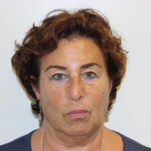 Facelift before at Farber Plastic Surgery in Delray Beach, FL