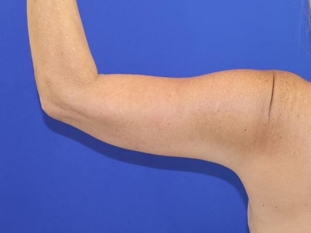 Arm Lift after at Farber Plastic Surgery in Delray Beach, FL