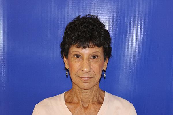 Farber Plastic Surgery brow lift after — Delray Beach, FL