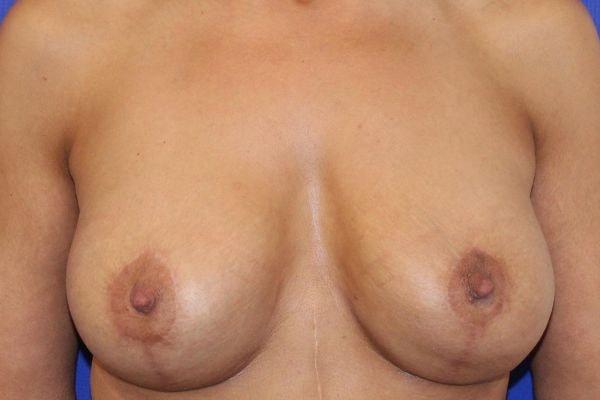 Farber Plastic Surgery breast augmentation revision after — Delray Beach, FL