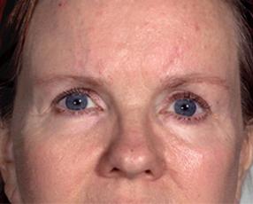 Brow Lift after at Farber Plastic Surgery in Delray Beach, FL