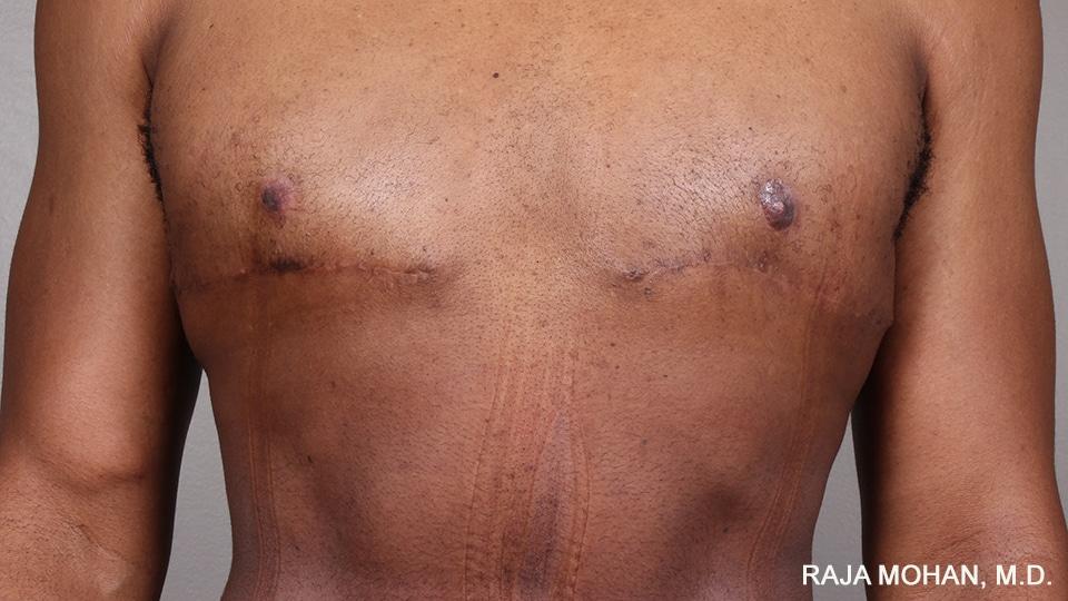 Dr. Raja Mohan Plastic Surgery result — Dallas, TX