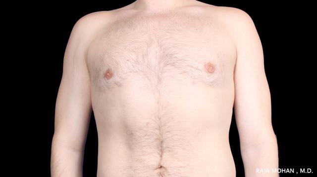 Gynecomastia Surgery after at Dr. Raja Mohan Plastic Surgery in Dallas, TX