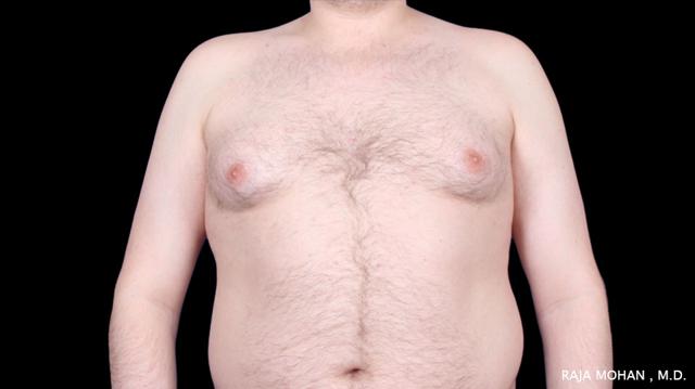 Gynecomastia Surgery before at Dr. Raja Mohan Plastic Surgery in Dallas, TX