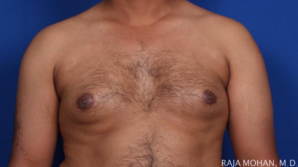 Dr. Raja Mohan Plastic Surgery result — Dallas, TX