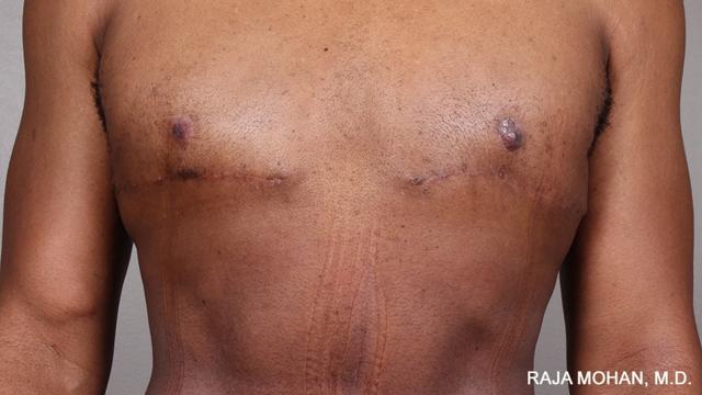 Gynecomastia Surgery after at Dr. Raja Mohan Plastic Surgery in Dallas, TX