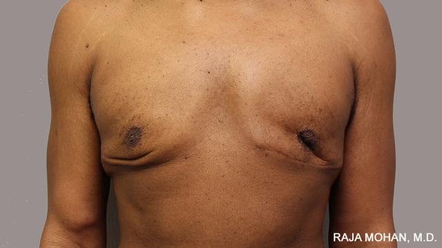 Gynecomastia Surgery before at Dr. Raja Mohan Plastic Surgery in Dallas, TX