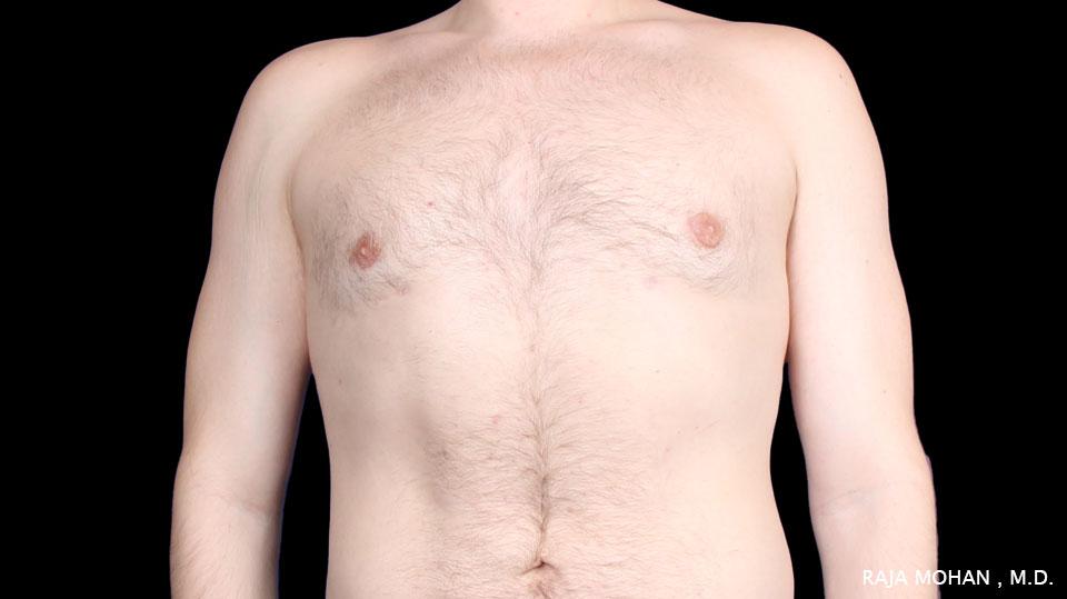 Dr. Raja Mohan Plastic Surgery result — Dallas, TX