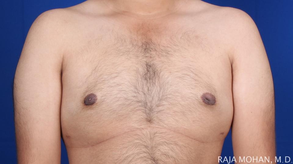 Dr. Raja Mohan Plastic Surgery result — Dallas, TX