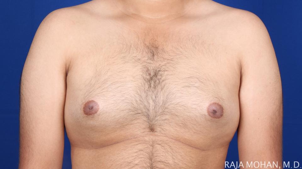 Dr. Raja Mohan Plastic Surgery result — Dallas, TX