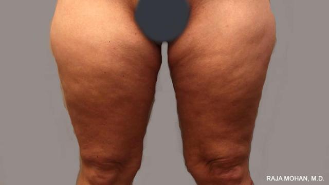 Thigh Lift after at Dr. Raja Mohan Plastic Surgery in Dallas, TX