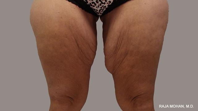Thigh Lift before at Dr. Raja Mohan Plastic Surgery in Dallas, TX