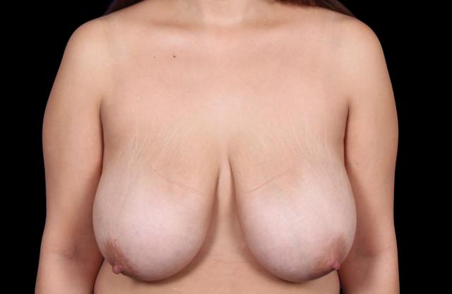 Breast Reduction before at Dr. Raja Mohan Plastic Surgery in Dallas, TX