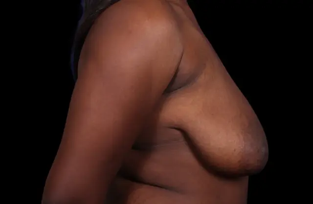 Breast Reduction before at Dr. Raja Mohan Plastic Surgery in Dallas, TX