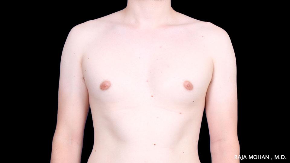 Dr. Raja Mohan Plastic Surgery result — Dallas, TX