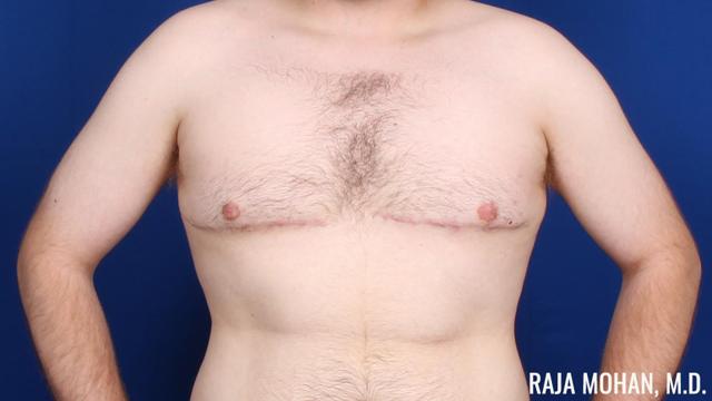 Gynecomastia Surgery after at Dr. Raja Mohan Plastic Surgery in Dallas, TX