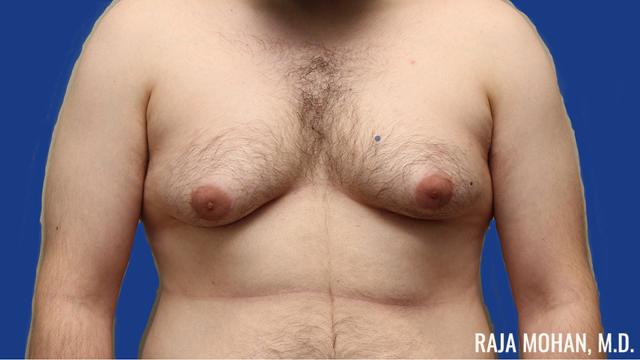 Gynecomastia Surgery before at Dr. Raja Mohan Plastic Surgery in Dallas, TX