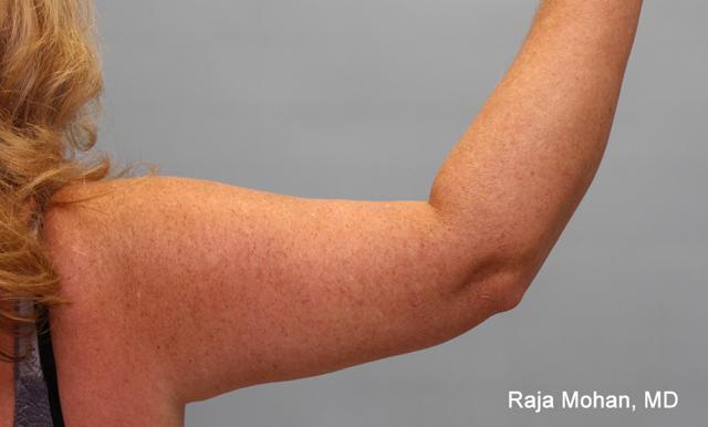 Arm Lift after at Dr. Raja Mohan Plastic Surgery in Dallas, TX