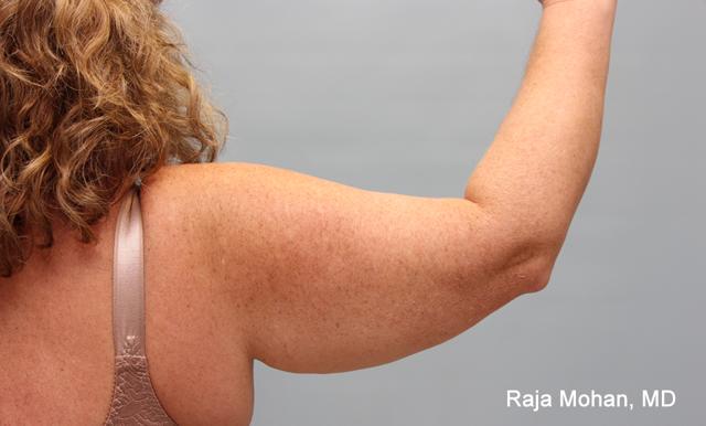 Arm Lift before at Dr. Raja Mohan Plastic Surgery in Dallas, TX