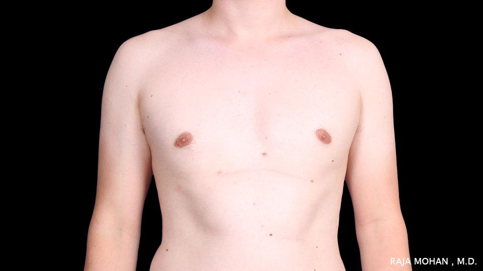 Dr. Raja Mohan Plastic Surgery result — Dallas, TX